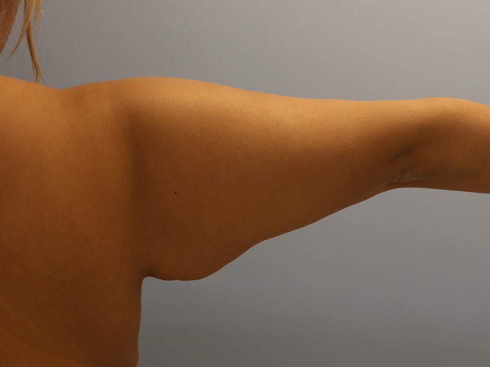 Armlift Before & After Image