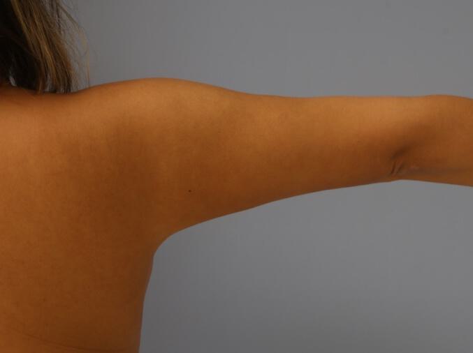 Armlift Before & After Image