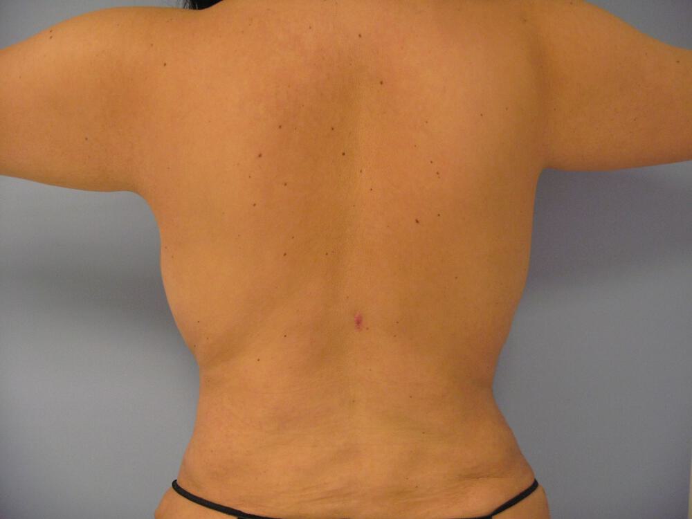 Bra Line Back Lift Before & After Image