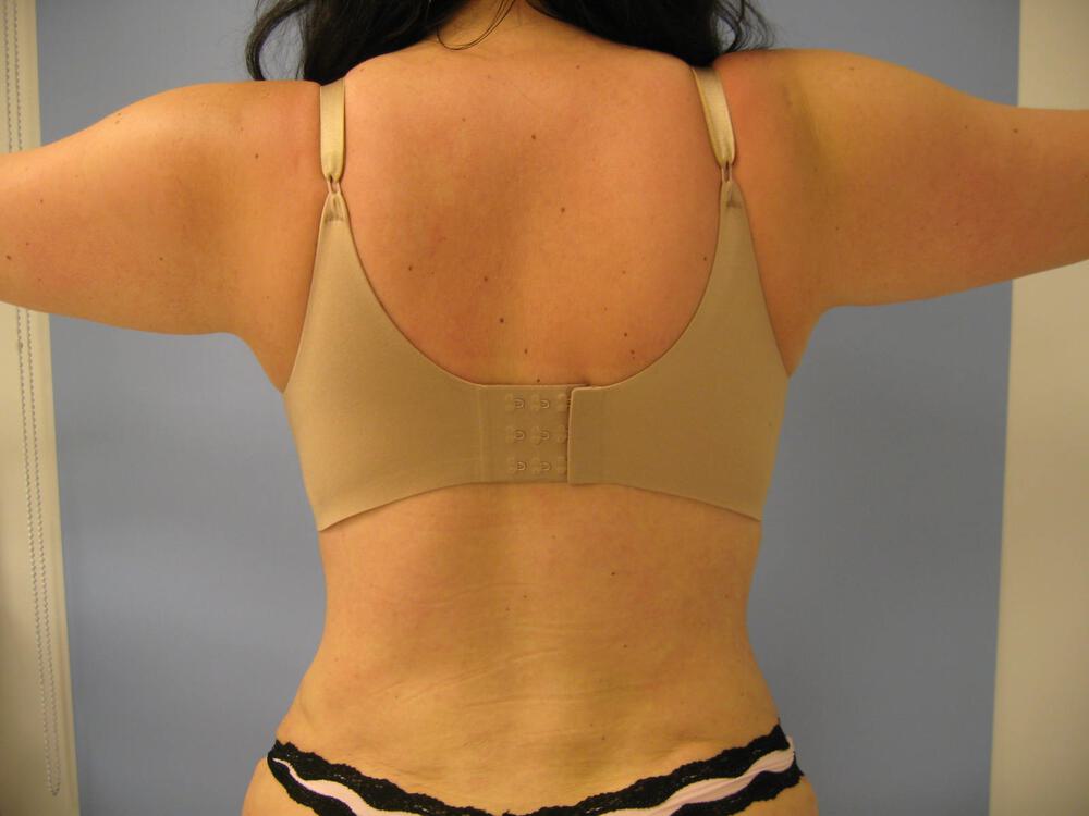 Bra Line Back Lift Before & After Image