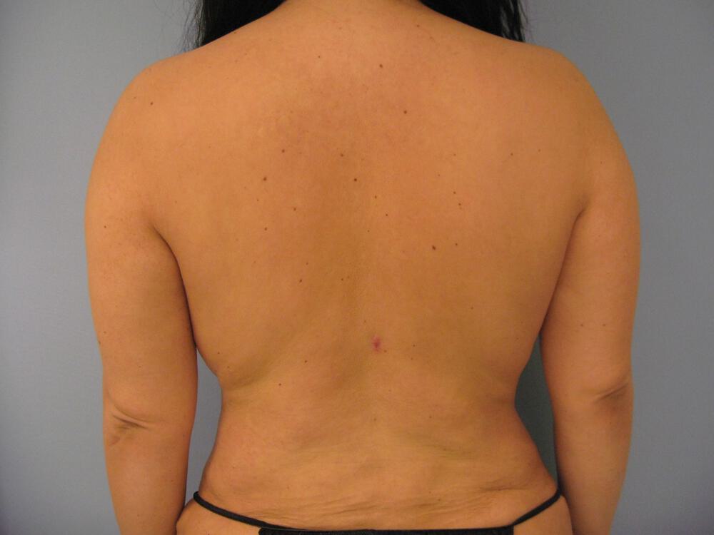 Bra Line Back Lift Before & After Image