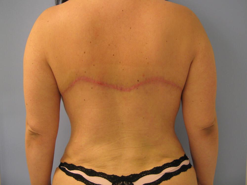 Bra Line Back Lift Before & After Image