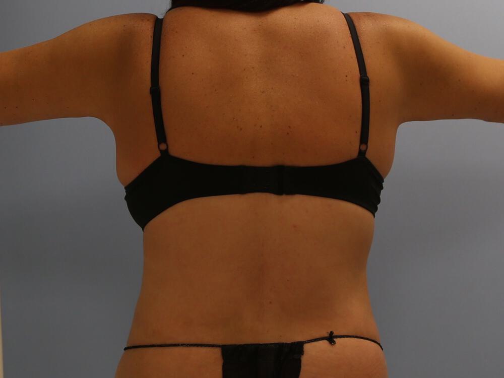 Bra Line Back Lift Before & After Image