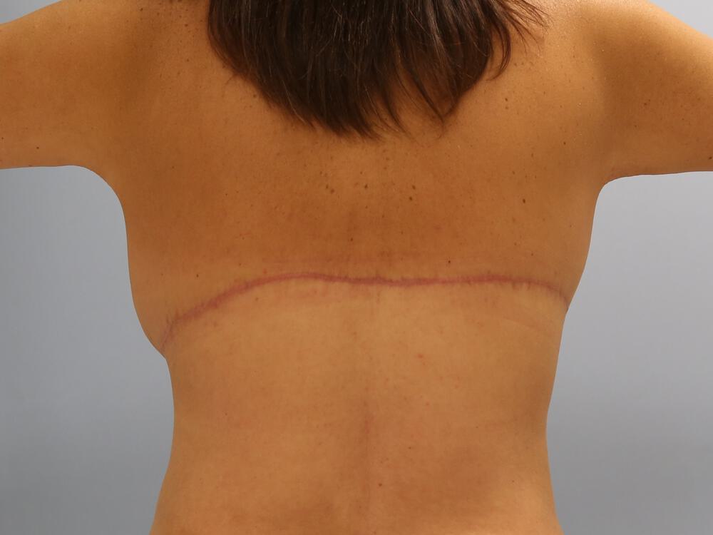 Bra Line Back Lift Before & After Image