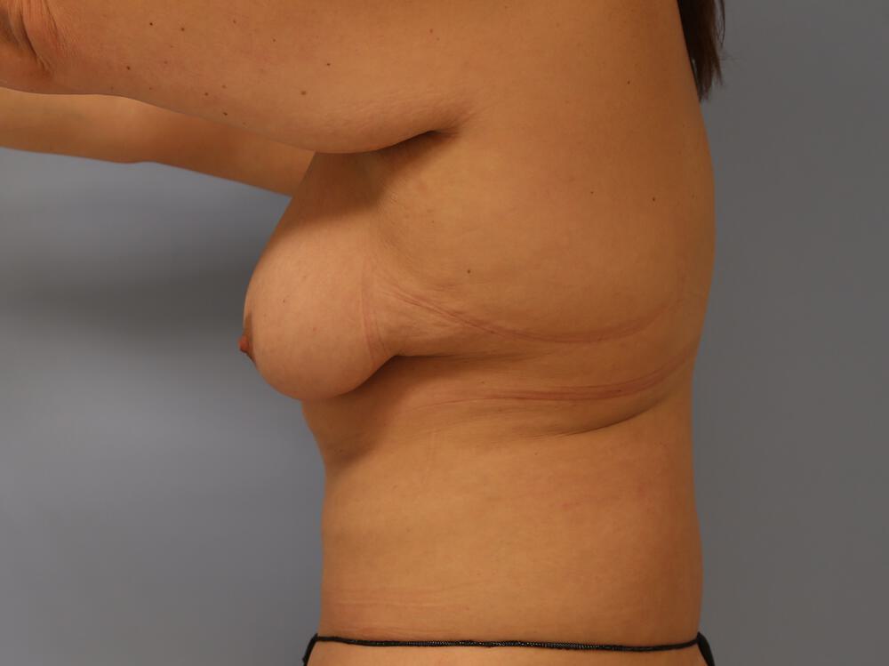 Bra Line Back Lift Before & After Image