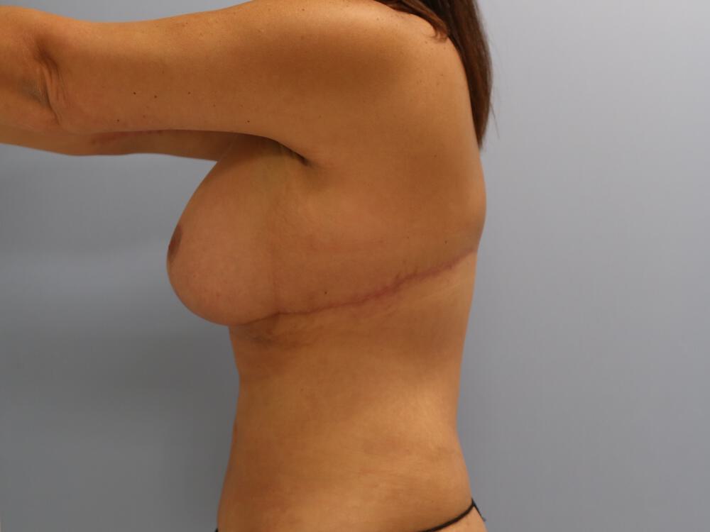 Bra Line Back Lift Before & After Image