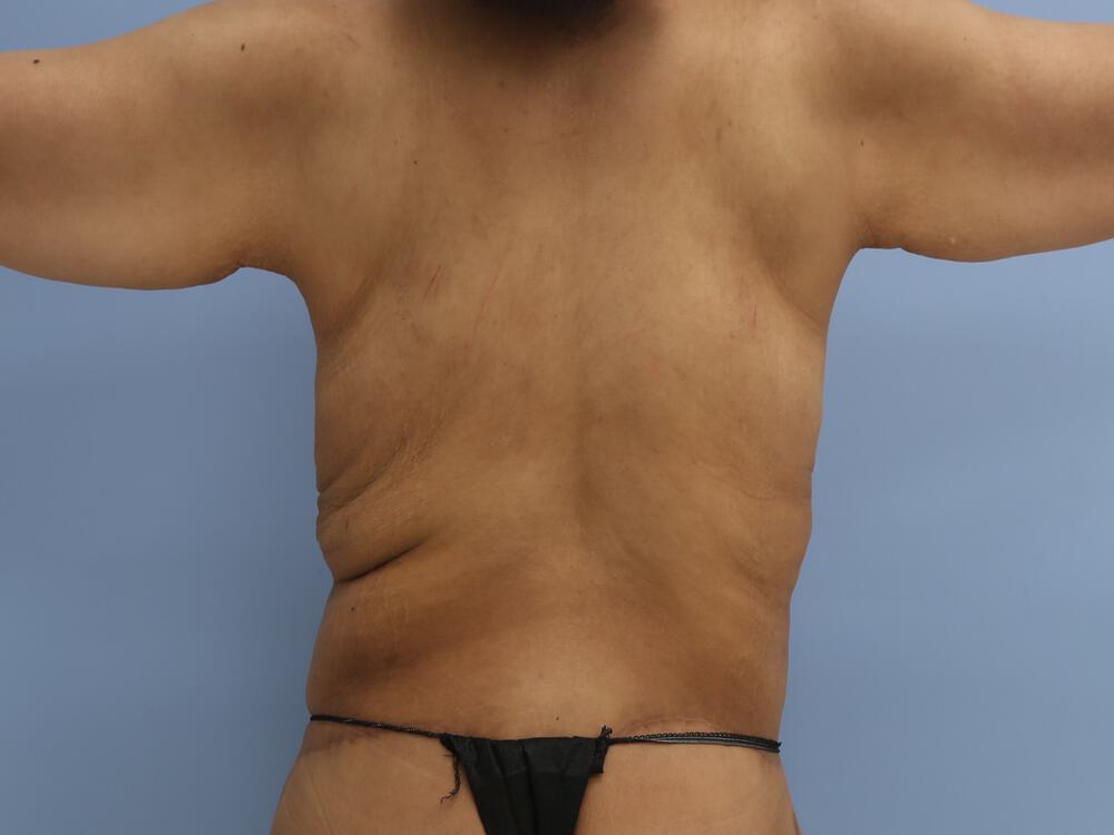 Braline backlift Before & After Image