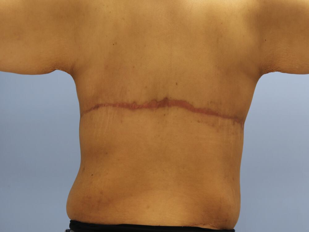 Braline backlift Before & After Image