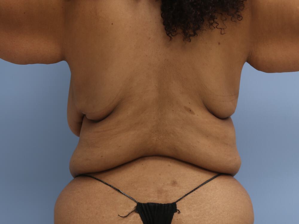 Braline backlift Before & After Image