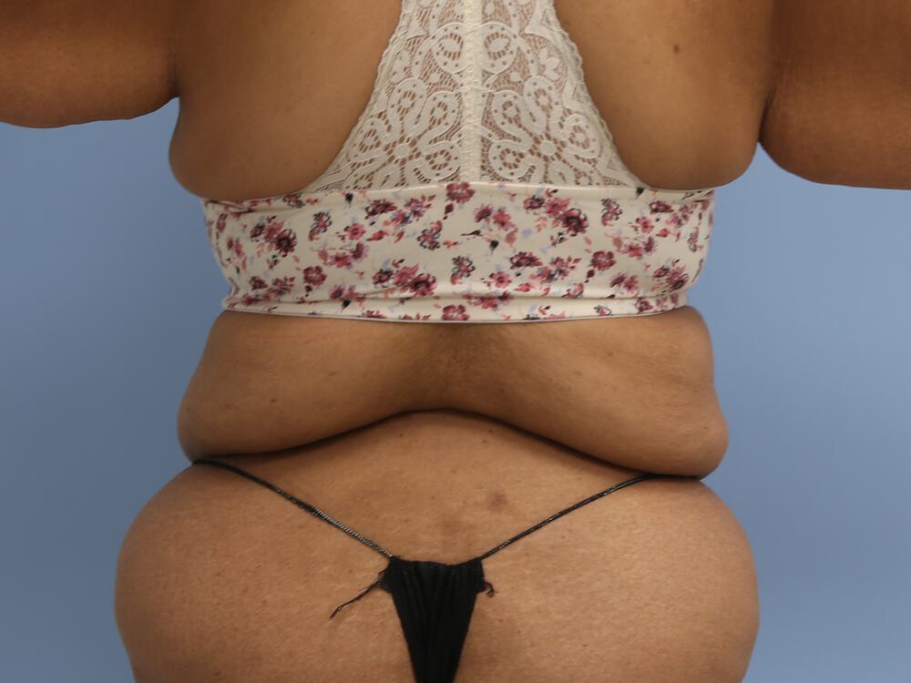 Braline backlift Before & After Image