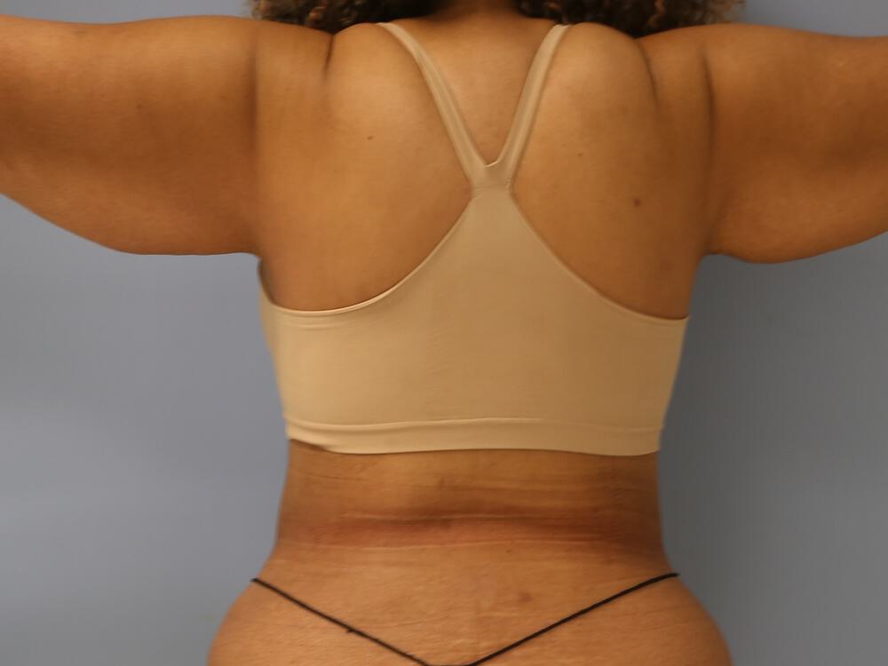 Braline backlift Before & After Image