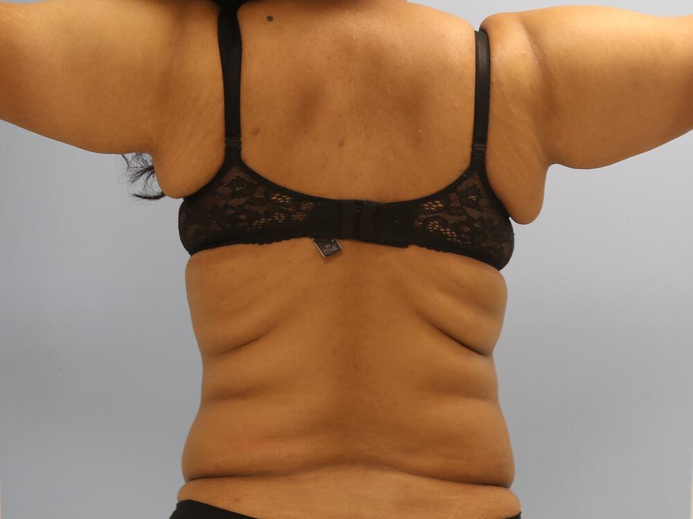 Braline backlift Before & After Image