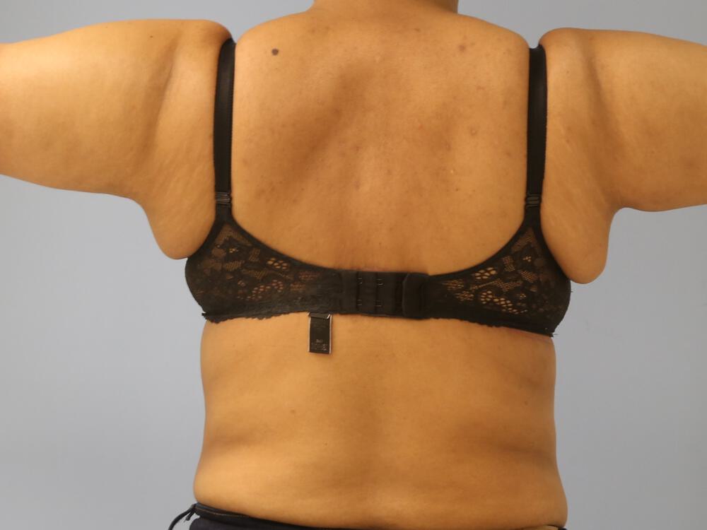 Braline backlift Before & After Image