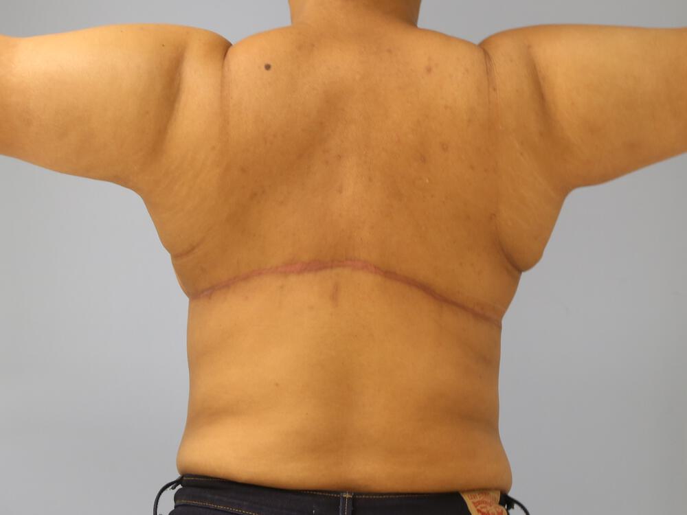 Braline backlift Before & After Image