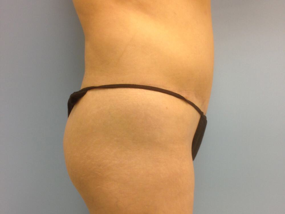 Buttocks Implants Before & After Image
