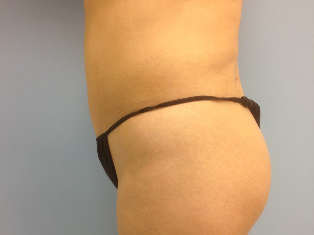 Buttocks Implants Before & After Image