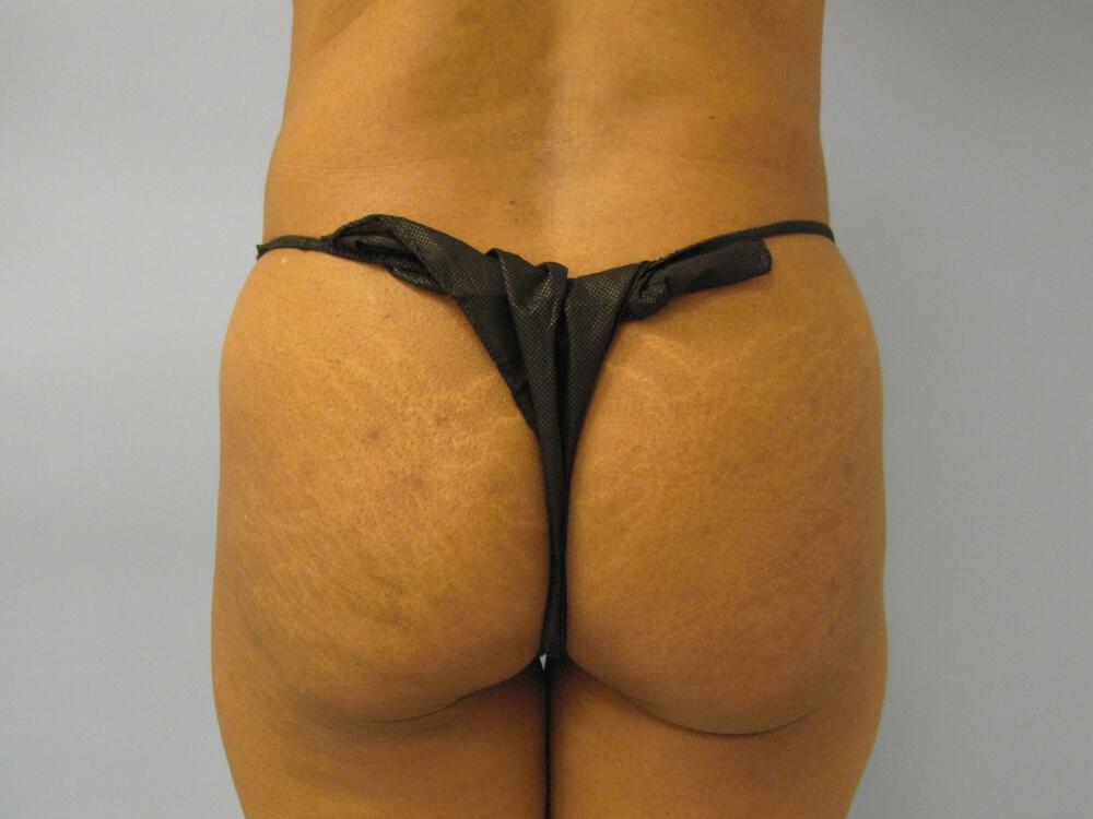 Buttocks Implants Before & After Image