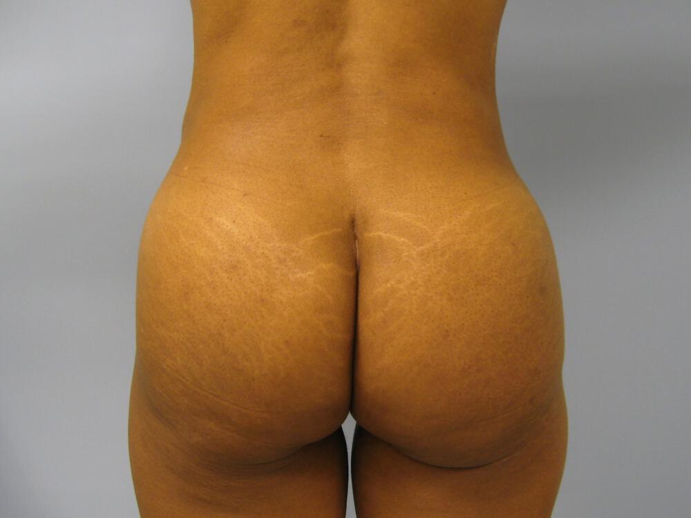 Buttocks Implants Before & After Image