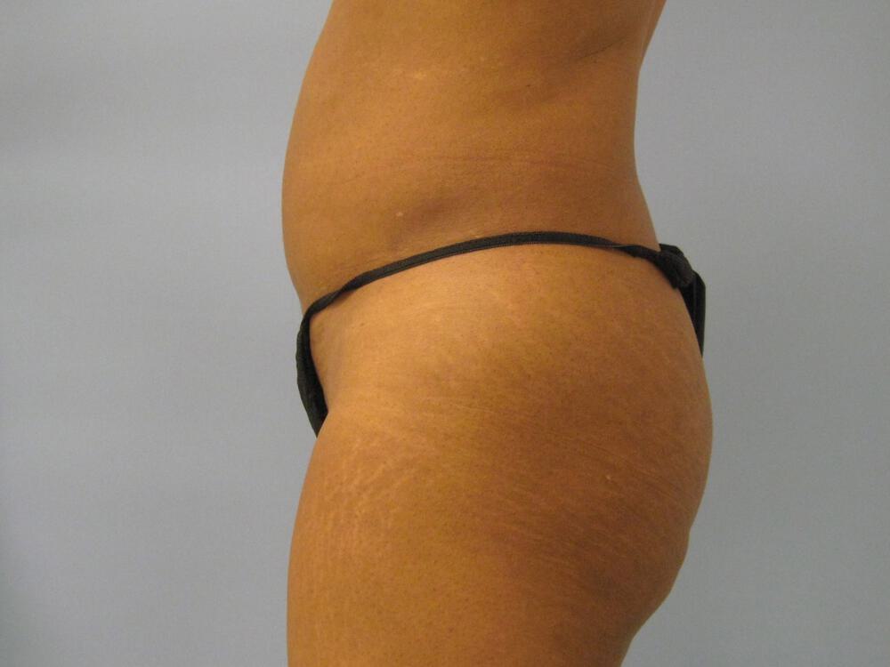 Buttocks Implants Before & After Image
