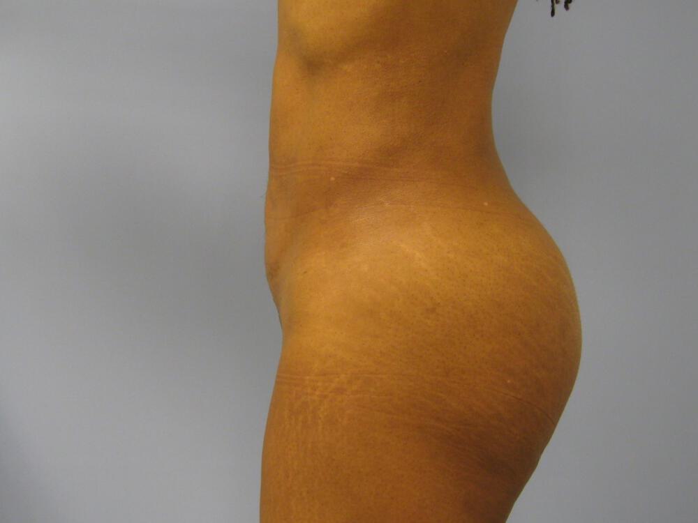 Buttocks Implants Before & After Image