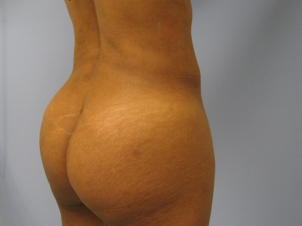 Buttocks Implants Before & After Image