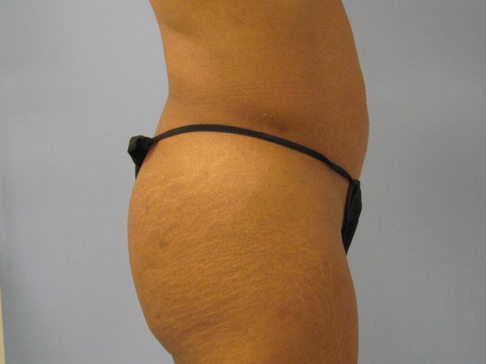 Buttocks Implants Before & After Image
