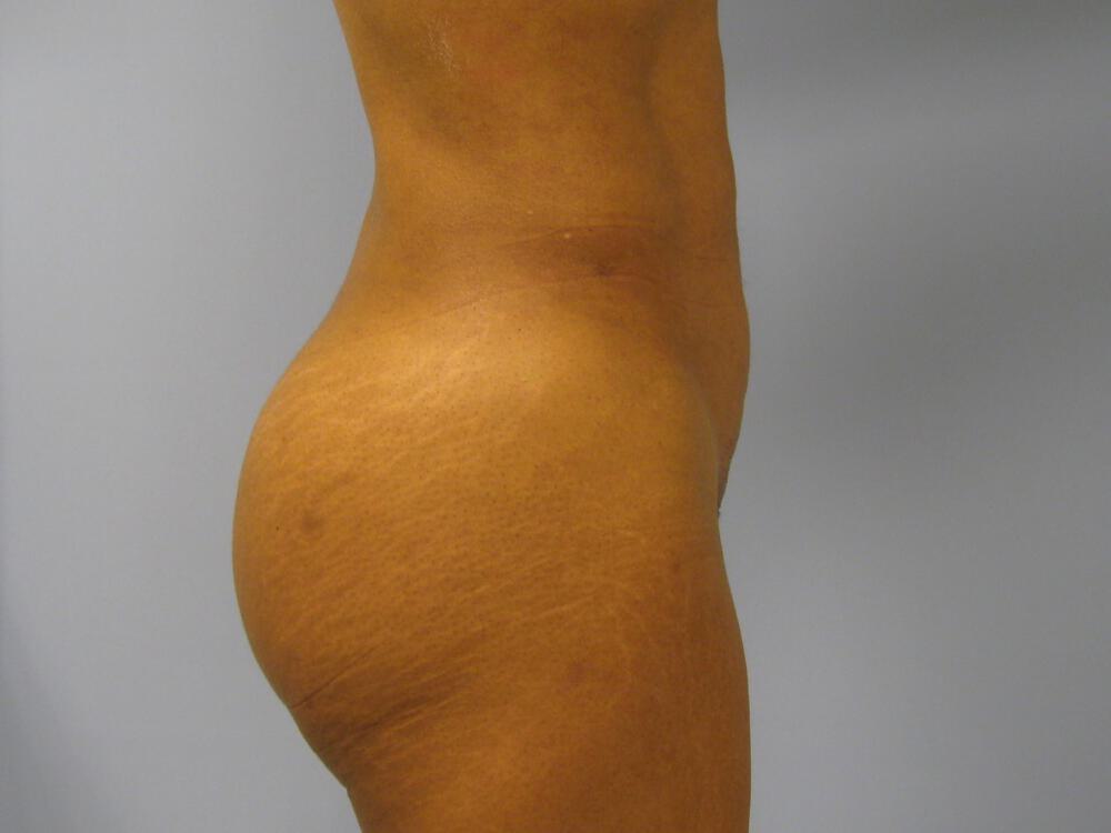 Buttocks Implants Before & After Image