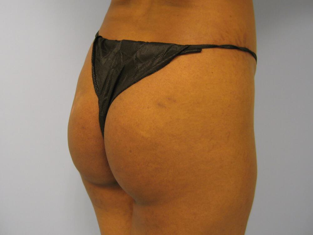 Buttocks Implants Before & After Image