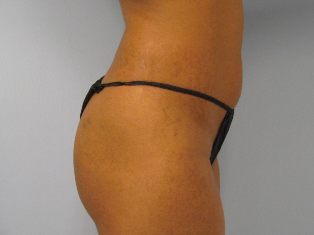 Buttocks Implants Before & After Image