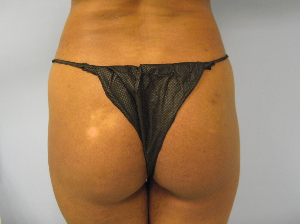 Buttocks Implants Before & After Image