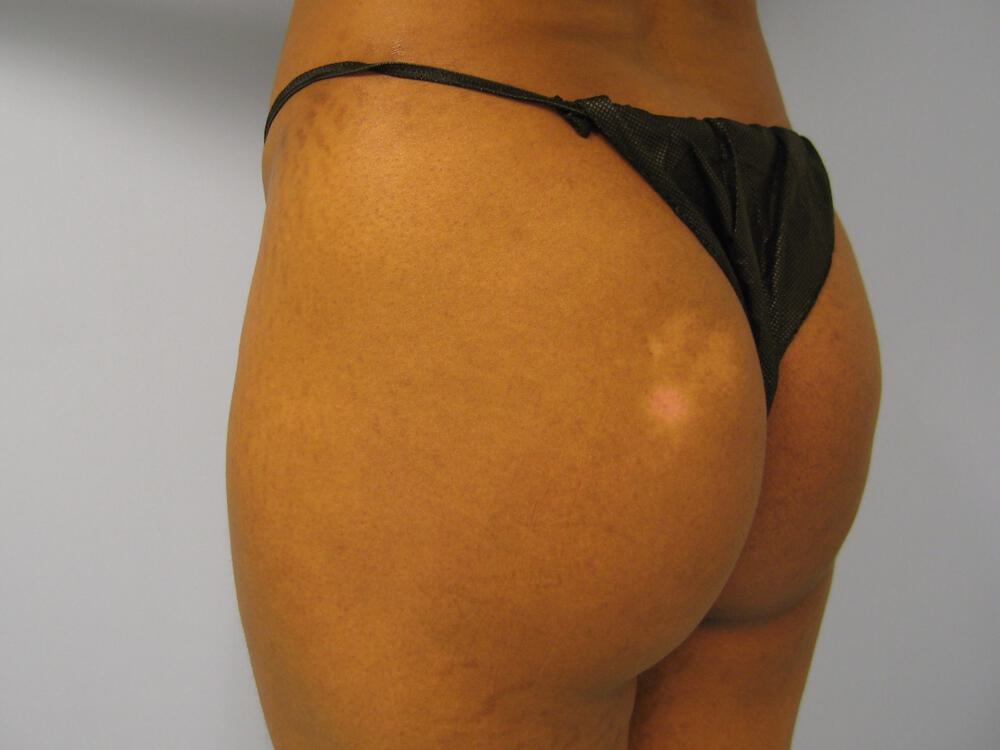 Buttocks Implants Before & After Image