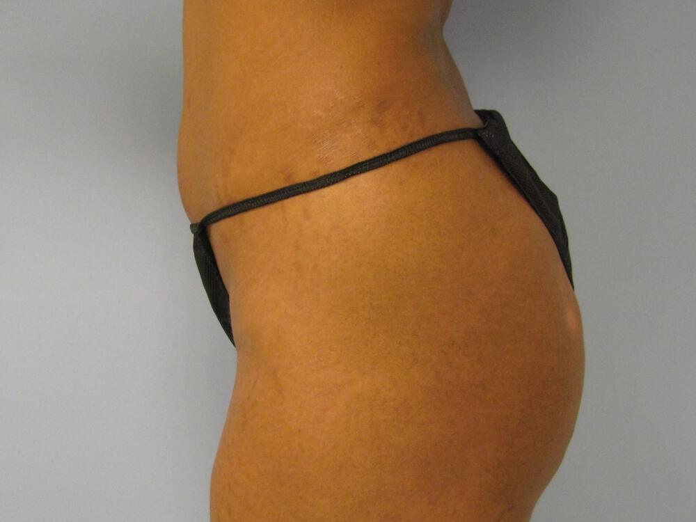 Buttocks Implants Before & After Image