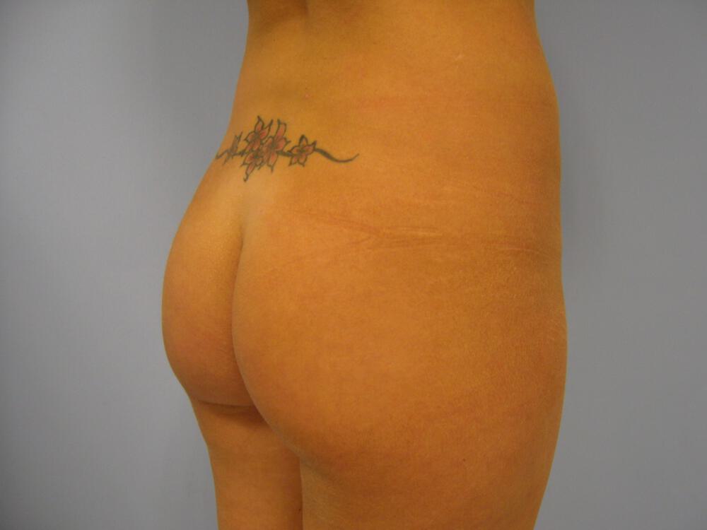 Buttocks Implants Before & After Image