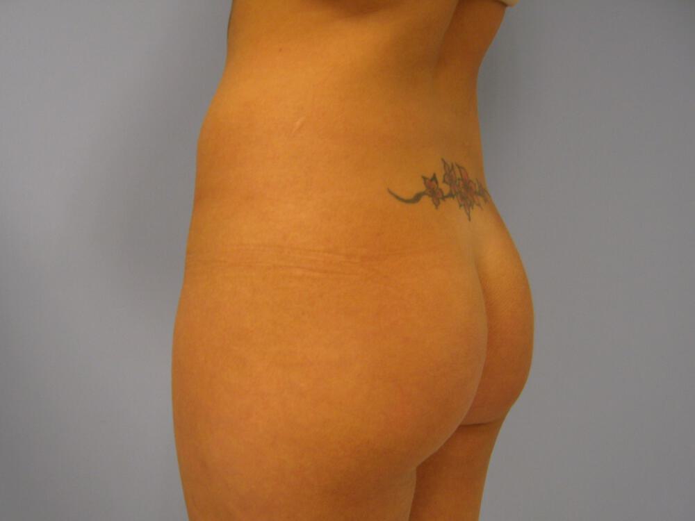 Buttocks Implants Before & After Image