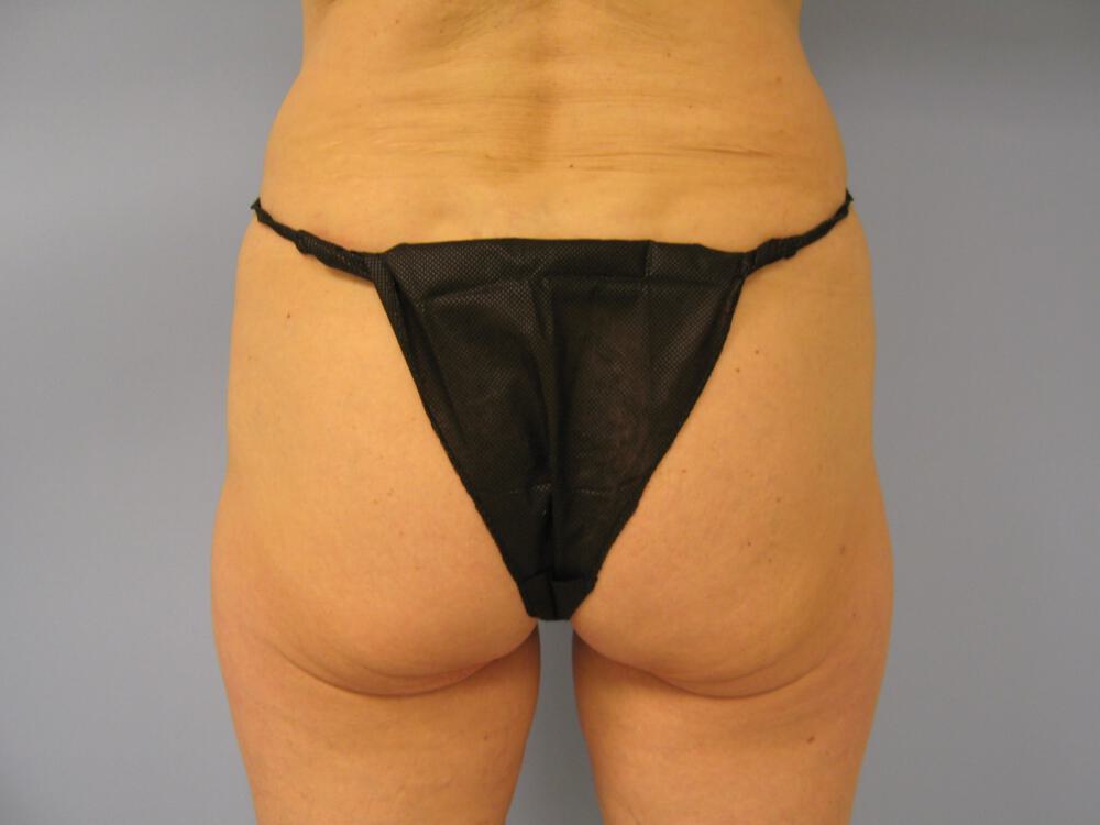 Buttocks Implants Before & After Image
