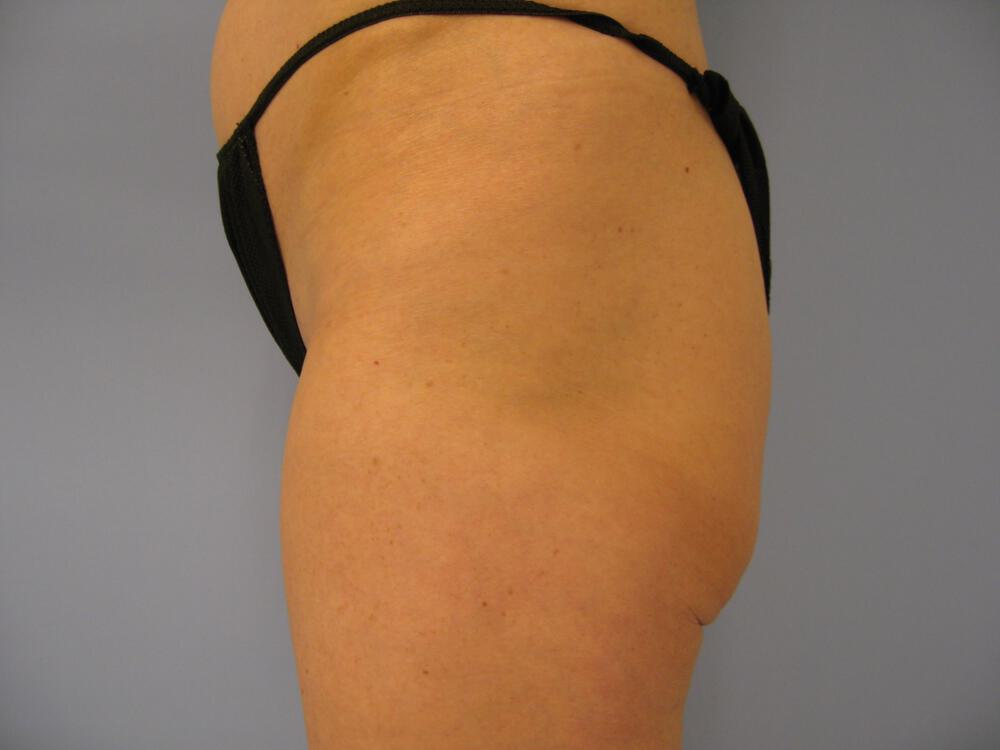 Buttocks Implants Before & After Image