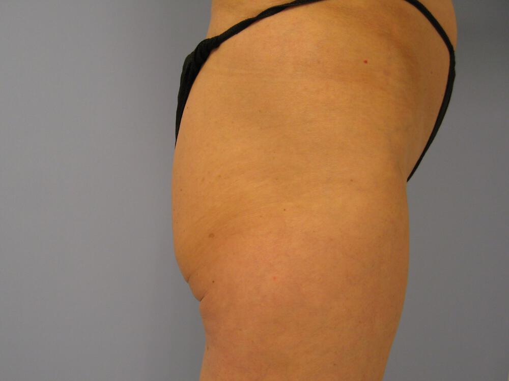 Buttocks Implants Before & After Image