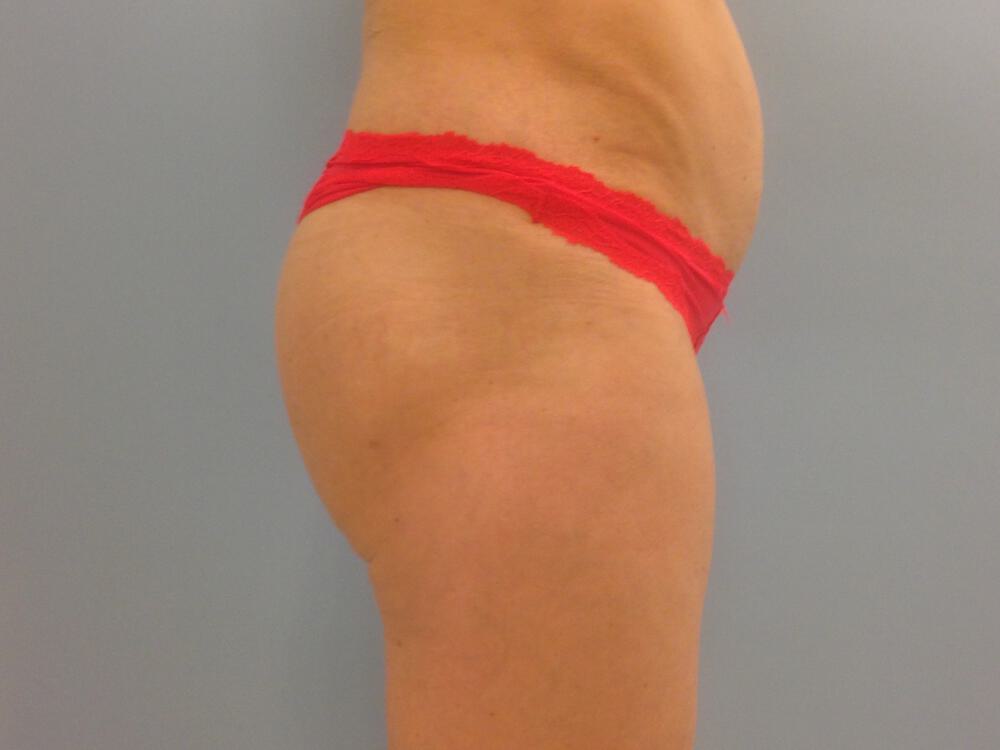 Buttocks Implants Before & After Image