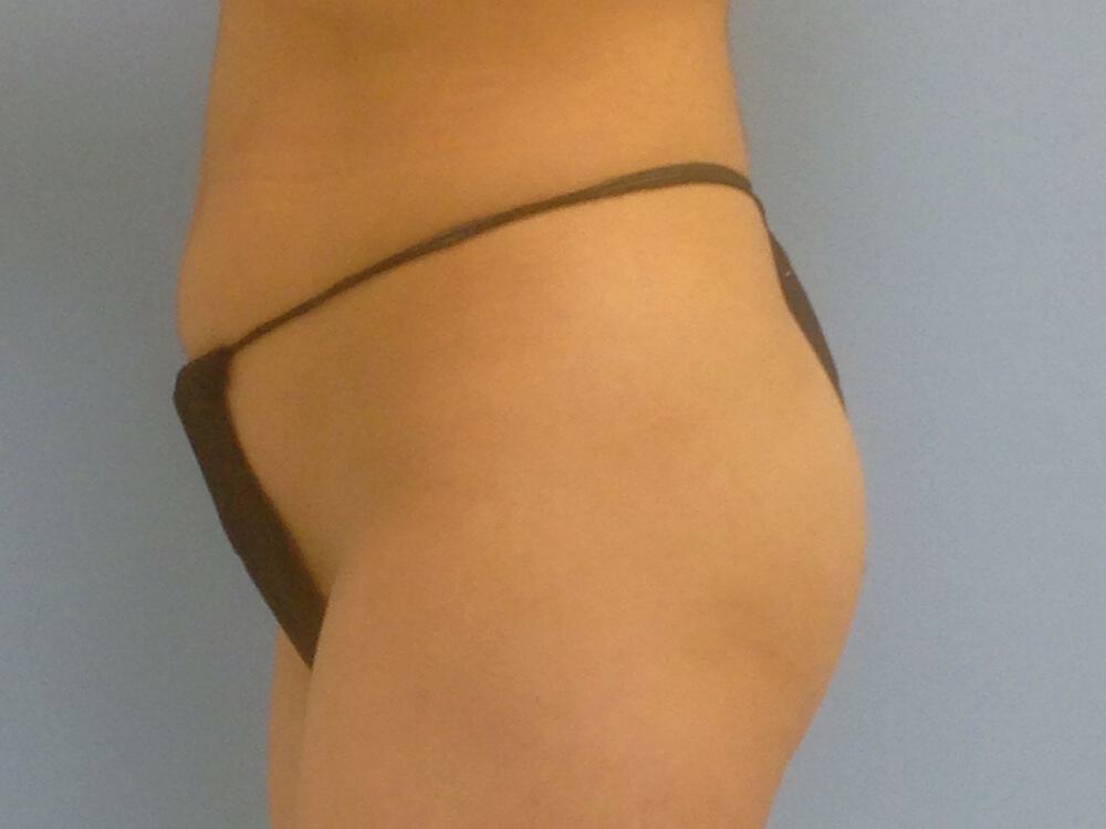 Buttocks Implants Before & After Image