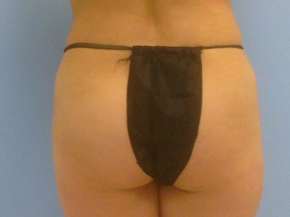 Buttocks Implants Before & After Image