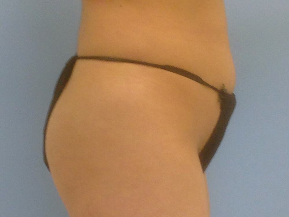 Buttocks Implants Before & After Image