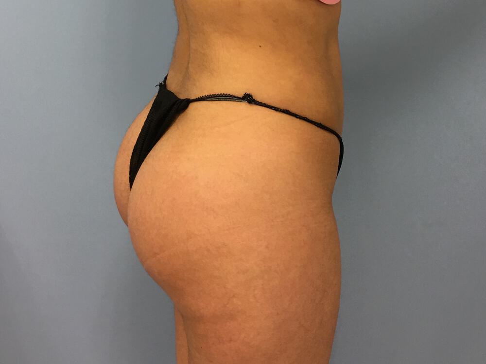 Buttocks Implants Before & After Image