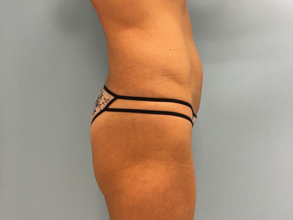 Buttocks Implants Before & After Image