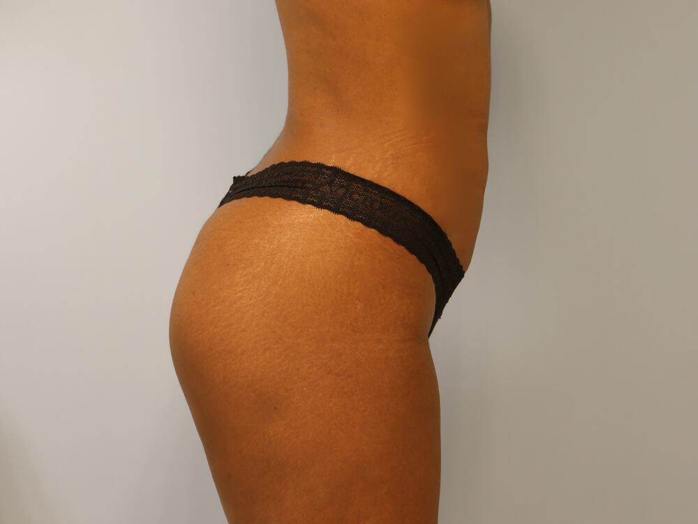 Buttocks Implants Before & After Image