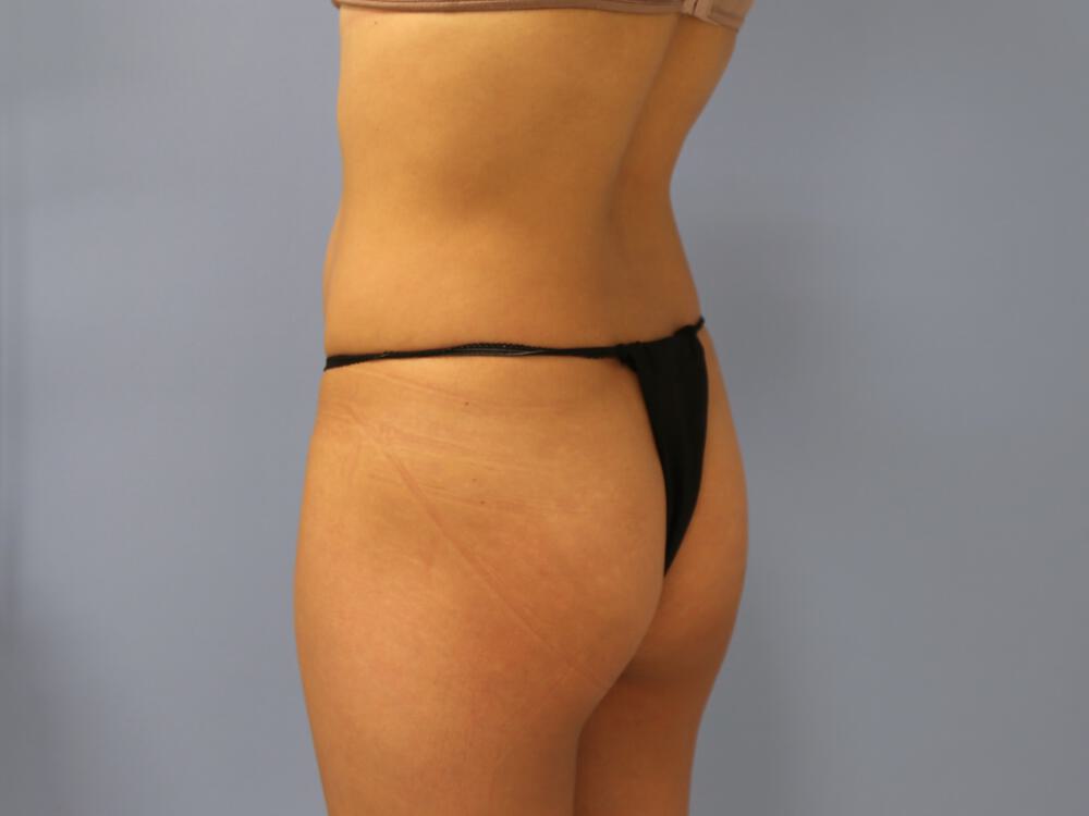Buttocks Implants Before & After Image