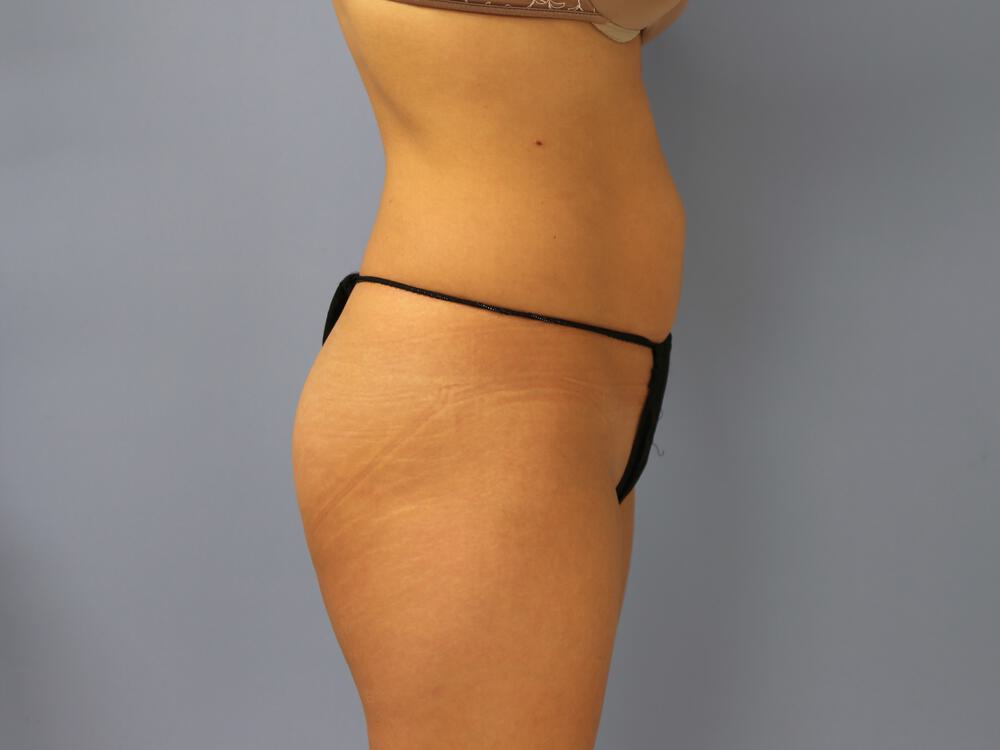 Buttocks Implants Before & After Image
