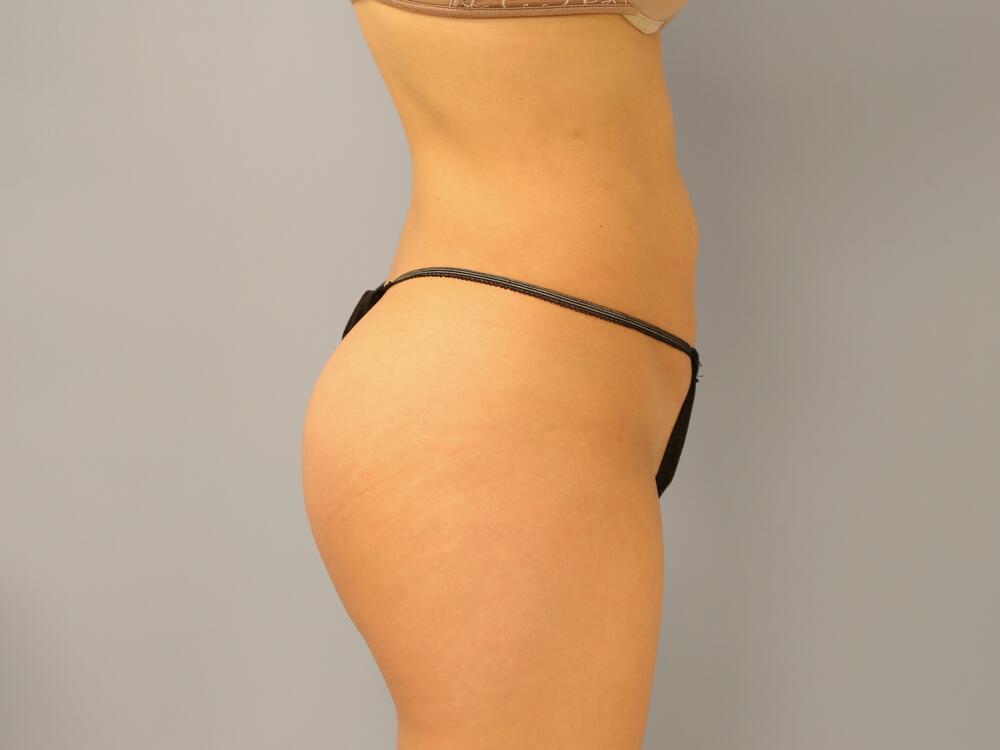 Buttocks Implants Before & After Image