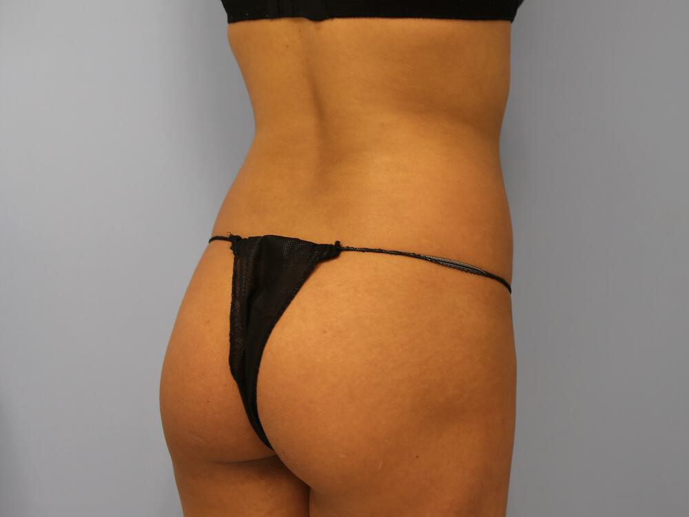 Buttocks Implants Before & After Image