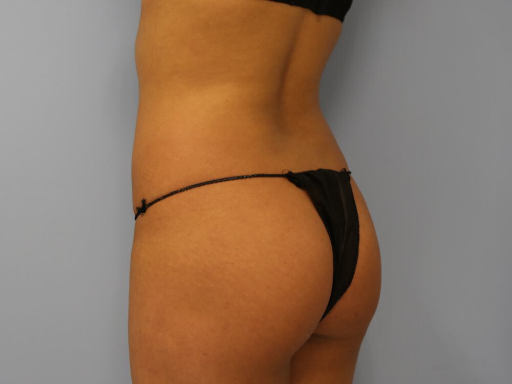 Buttocks Implants Before & After Image