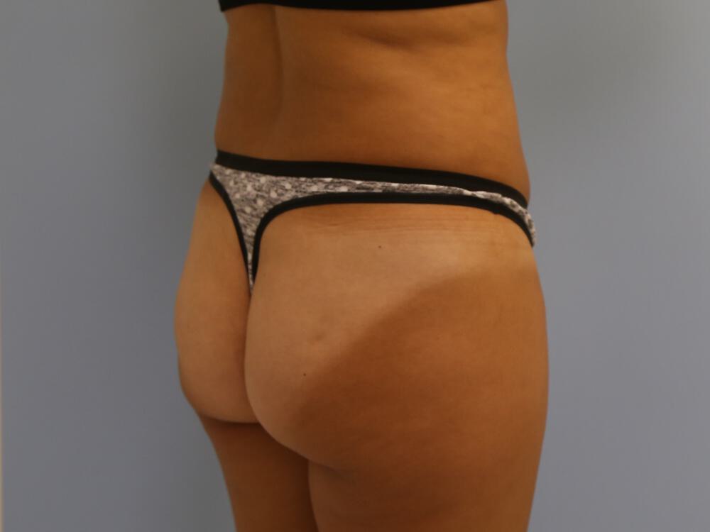 Buttocks Implants Before & After Image